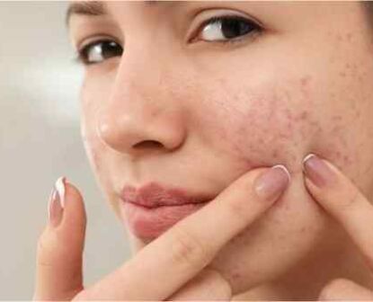 acne-myths