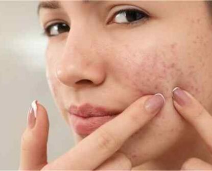 acne-myths