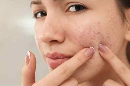 acne-myths