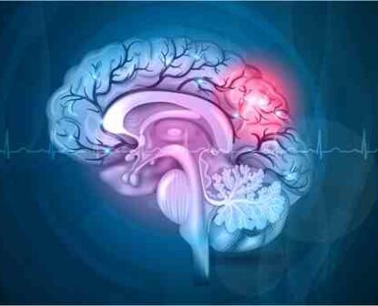 Understanding the Difference between stroke and Seizure