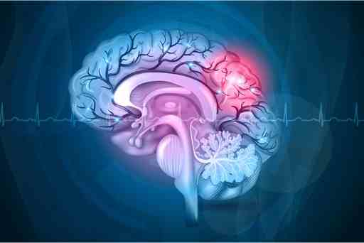 Understanding the Difference between stroke and Seizure