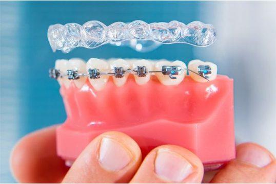 dental braces