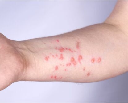 MONKEYPOX PROTECT Yourself