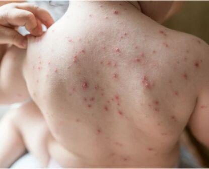 What To Do When Your Child Has A Rash