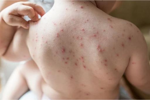 What To Do When Your Child Has A Rash